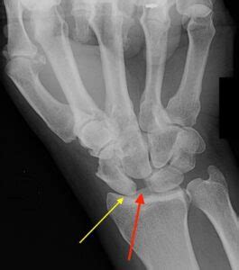 test for scapholunate ligament tear|scapholunate ligament rupture.